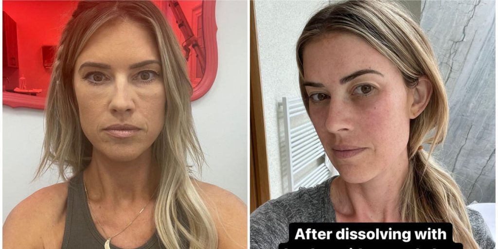 Christina Hall will never use "inflammatory" under-eye fillers again